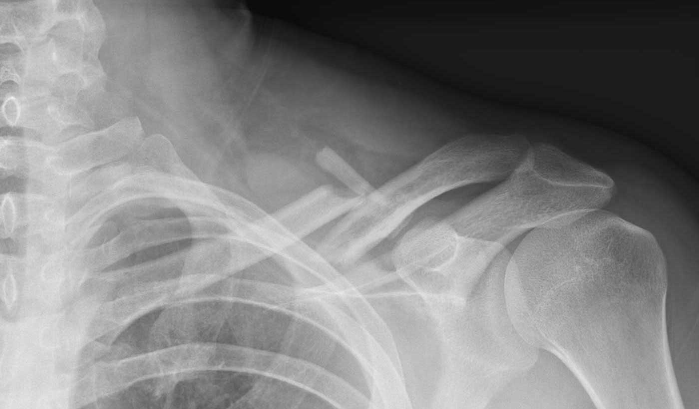 FIXATION FOR CLAVICLE